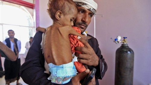 اليمنيون يعانون من